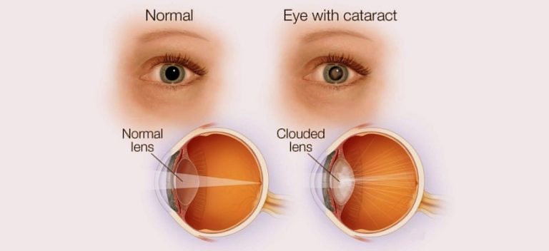 Best Cataract Treatment in Nagpur