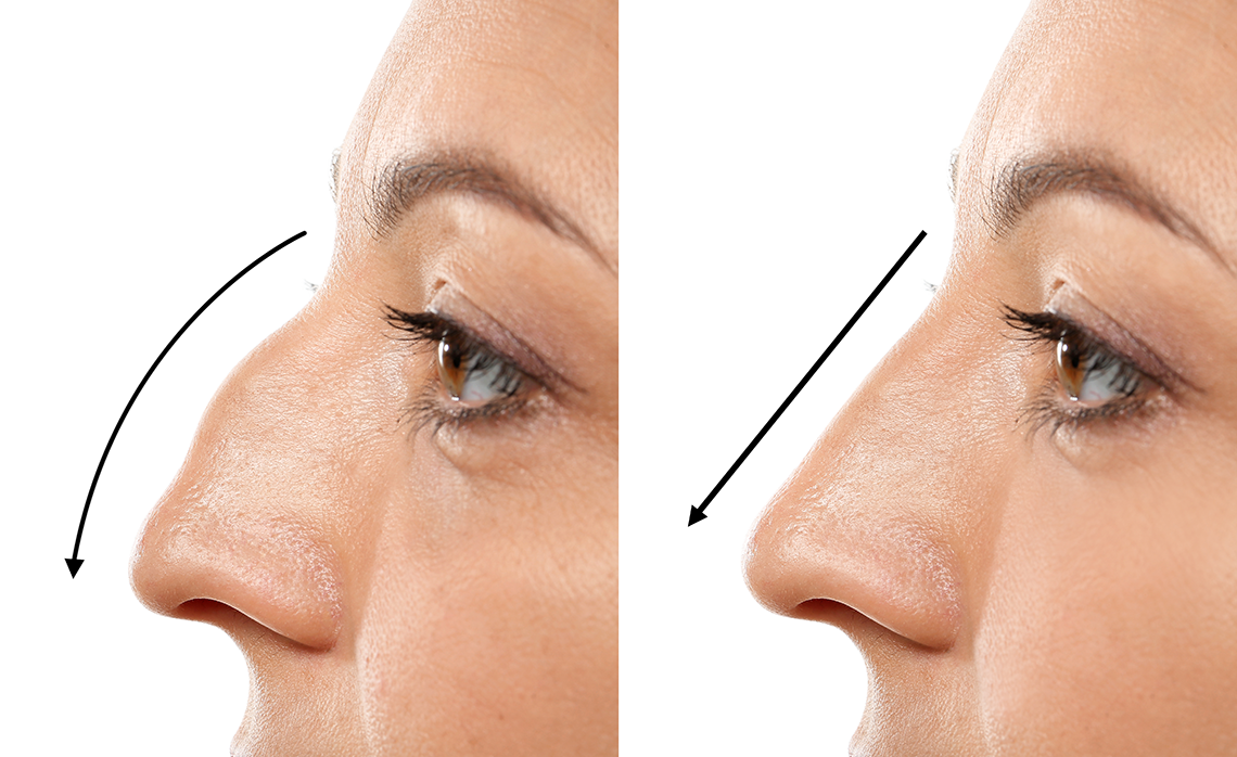 Rhinoplasty Non Surgical nose Job ENT Surgeon Doctor near me