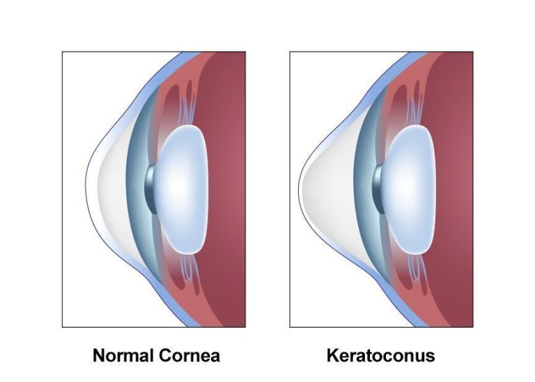 Keratoconus Specialist in Nagpur