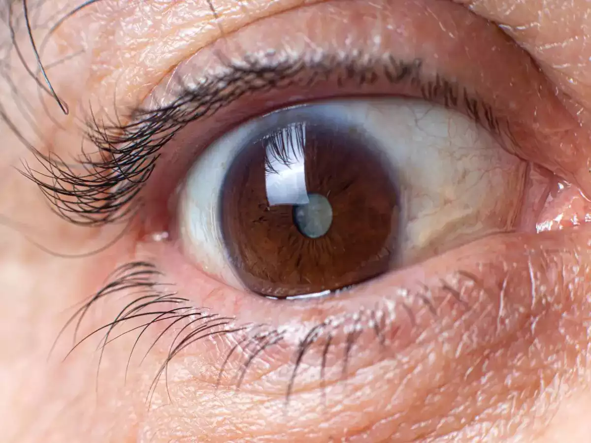 eye shows motiyabindu