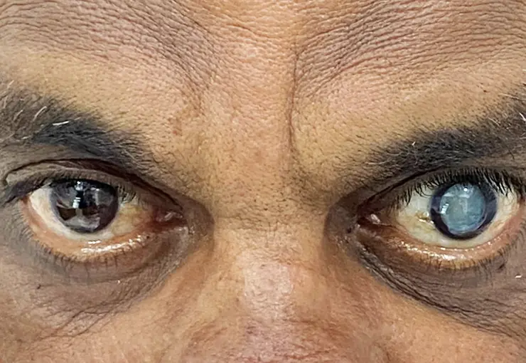 one eye is normal and second is motiyabindu eye