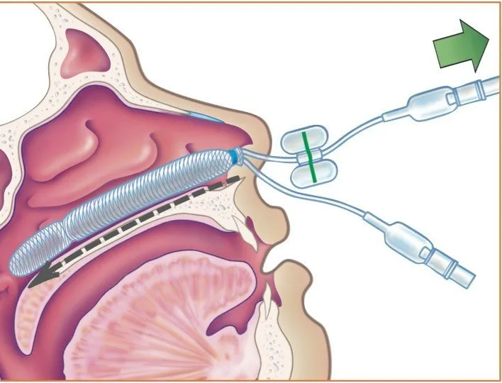 injection tubes feeling with liquid medicine insert to nose