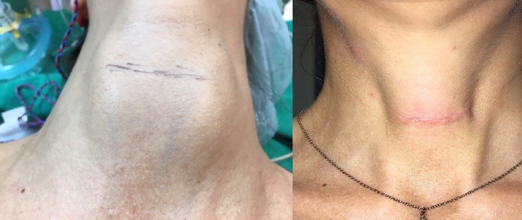 close up pic Patient's Neck during Thyroid Surgery