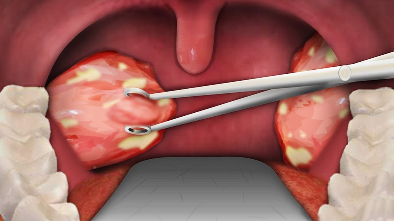 tonsil remove during surgery