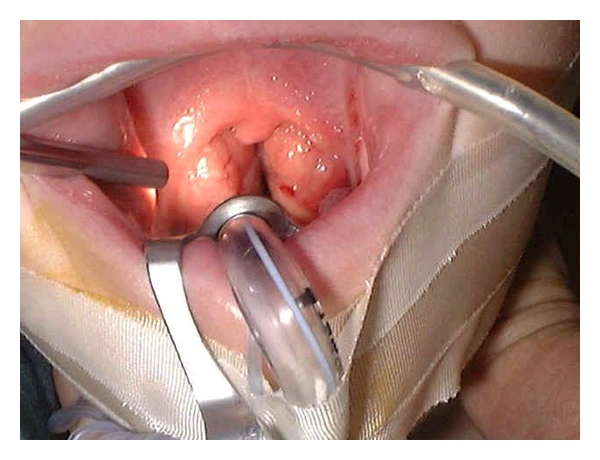 tonsils cells remove during surgery